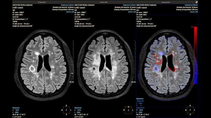 Mettre en &eacute;vidence les changements neurologiques subtils au fil du temps