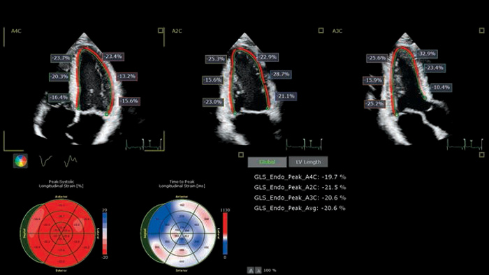 X5 1C Examen d&rsquo;imagerie AutoStrain
