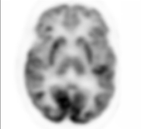 Examen d&rsquo;imagerie TEP analogique du cerveau