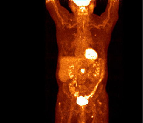 Examen d’imagerie TEP numérique Vereos du thorax