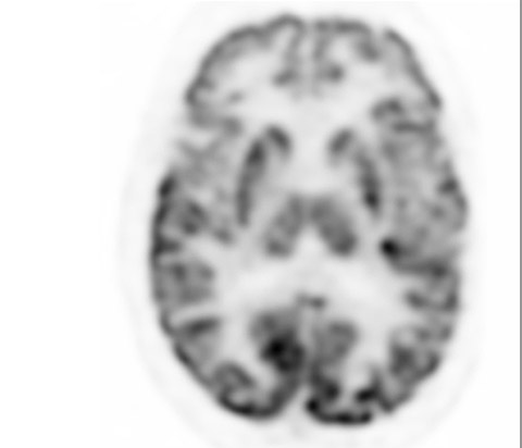 Examen d&rsquo;imagerie TEP num&eacute;rique Vereos du cerveau