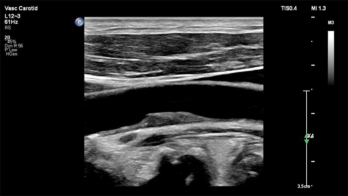 diagnostic fiable durant l&rsquo;imagerie vasculaire